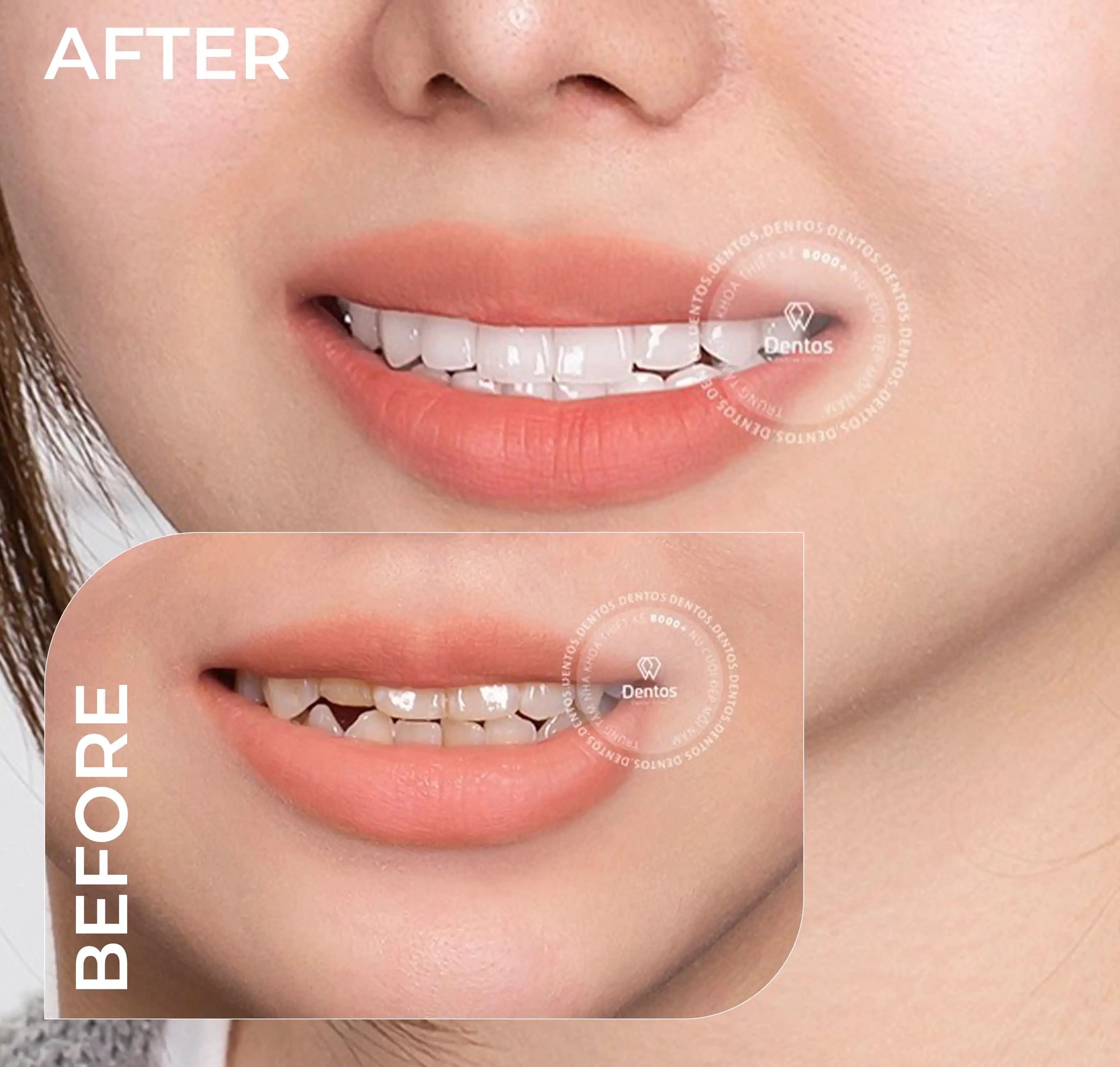 Hình ảnh before – after: răng sứ bị mẻ nhẹ được phục hồi bằng dán Veneer